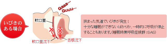 いびきのある場合