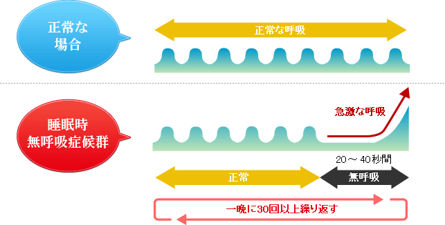 睡眠時無呼吸症候群