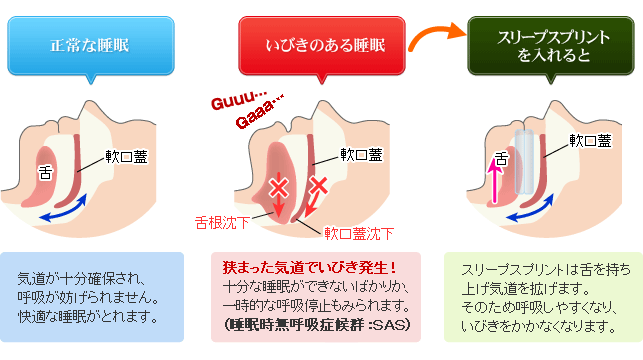 スリープスプリントによる睡眠時無呼吸症候群・いびき対策図