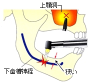 インプラント