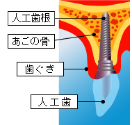 インプラント/イメージ図