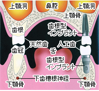 インプラント/イメージ図