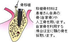 骨移植