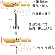 骨移植