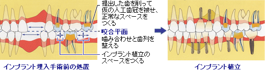 インプラント治療