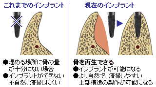 インプラント治療