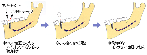 インプラント埋入手術後の治癒期間