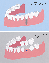 インプラントとブリッジ