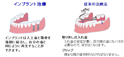 インプラント治療と従来の治療法