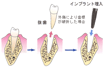 インプラント抜歯同時埋入法