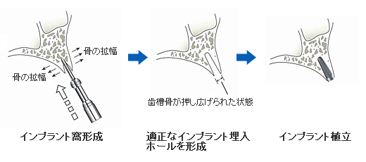 インプラント埋入手術−リッジエキスパンジョン