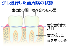 少し進行した歯周病の状態