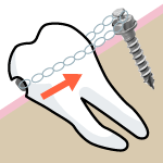 顎の骨を固定源にするインプラント矯正