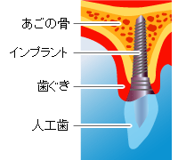 インプラントの構造