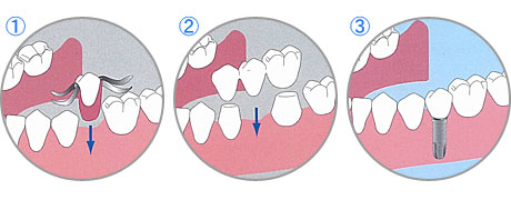 義歯・ブリッジ・インプラント