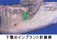 下顎のインプラント計画例