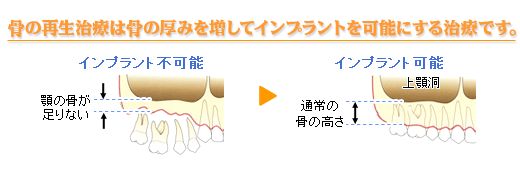 骨の再生治療は骨の厚みを増してインプラントを可能にする治療です。