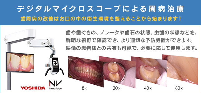 デジタルマイクロスコープによる歯周治療、予防処置